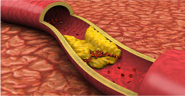 高血脂|血脂高不高，看脸就知道！脸部有这3种表现，说明血脂已飙升