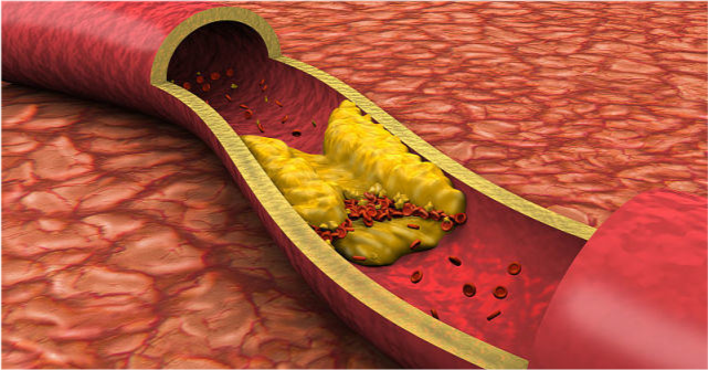 高血脂|我这么瘦，怎么被高血脂盯上了！3招教你如何避免高血脂“青睐”