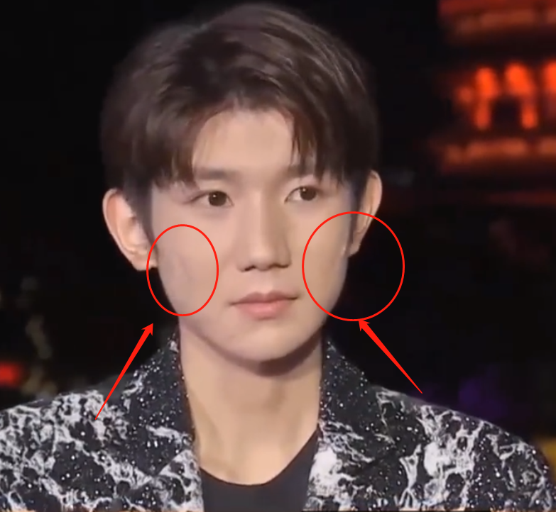 所以长一些小痘痘和粉刺还是非常正常的,所以王源脸上有痘痘也是很