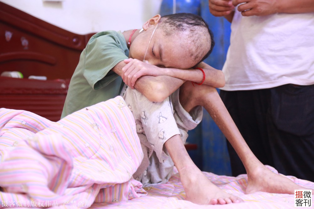 12岁男孩瘦成皮包骨24小时吸氧,姐姐掏鸡粪救患病弟弟_腾讯新闻