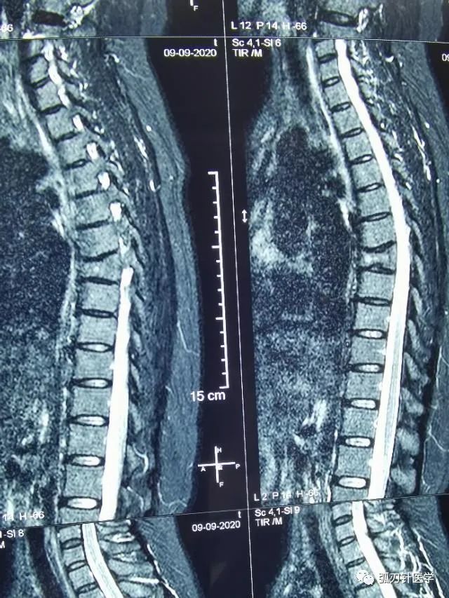 磁共振及多排ct平扫 重建,显示患者第6,7肋骨及第7胸椎骨肿瘤