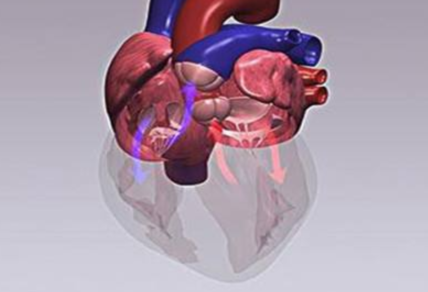 室间隔缺损|室间隔缺损是什么病