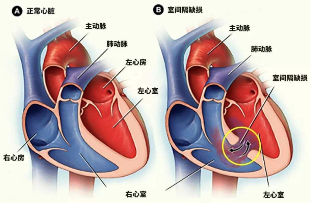 室间隔缺损|室间隔缺损是什么病