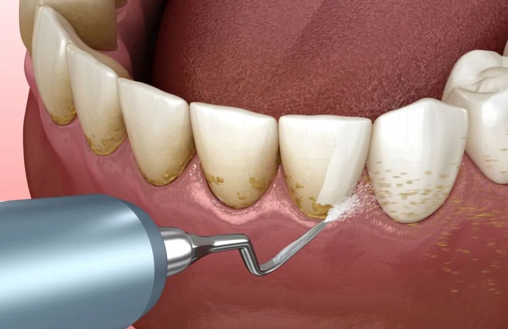 洗牙|每一个中国人，都应该好好去洗牙！