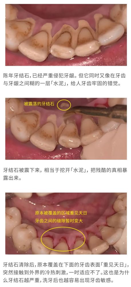 洗牙|每一个中国人，都应该好好去洗牙！