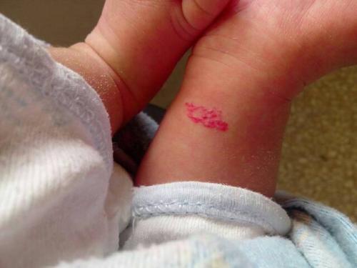 小腿有红色血点该怎么办