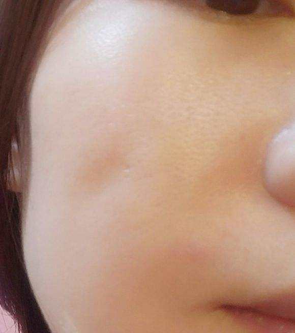 面部埋线|姐姐面部埋线后脸胖胖的，面部埋线后腮帮子胖了姐夫直呼吓傻了