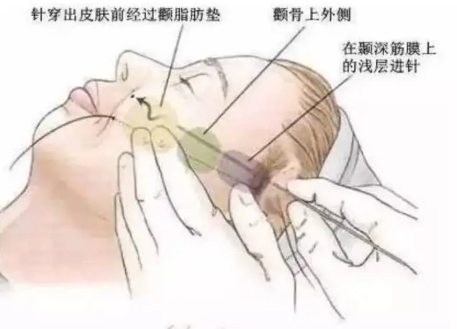 面部埋线|姐姐面部埋线后脸胖胖的，面部埋线后腮帮子胖了姐夫直呼吓傻了