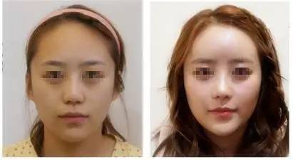 面部埋线|姐姐面部埋线后脸胖胖的，面部埋线后腮帮子胖了姐夫直呼吓傻了