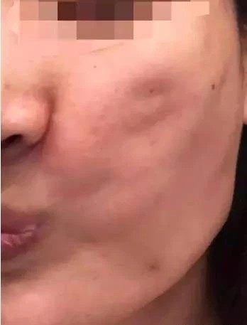 面部埋线|姐姐面部埋线后脸胖胖的，面部埋线后腮帮子胖了姐夫直呼吓傻了