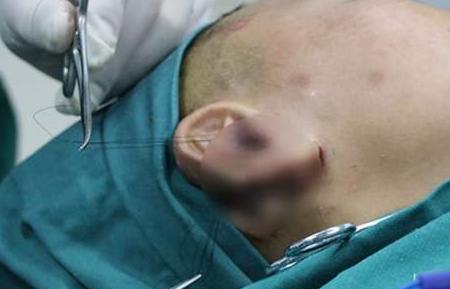 杯状耳——常见的耳朵畸形