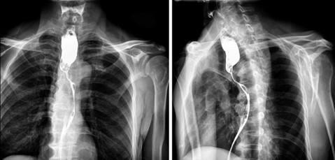 1.髓质型,顾名思义,其外观形态呈灰白色致密组织.