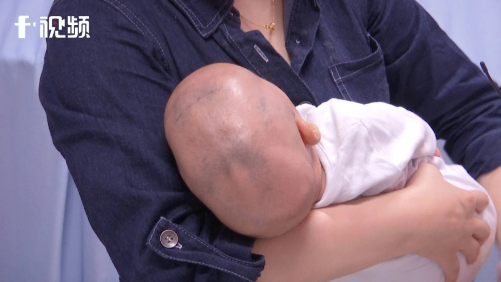 湖南已发现多例七个月大宝宝头型酷似外星人医生一句话惊醒家长