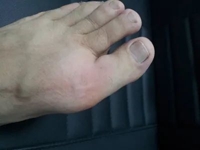 痛风发作关节红肿?注意:不要吃消炎药!