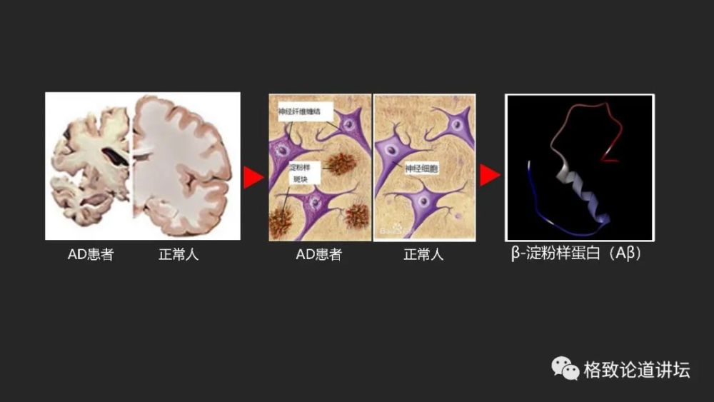 阿尔茨海默症|“百年孤独”的阿尔茨海默症，只有一个黄金治疗时间