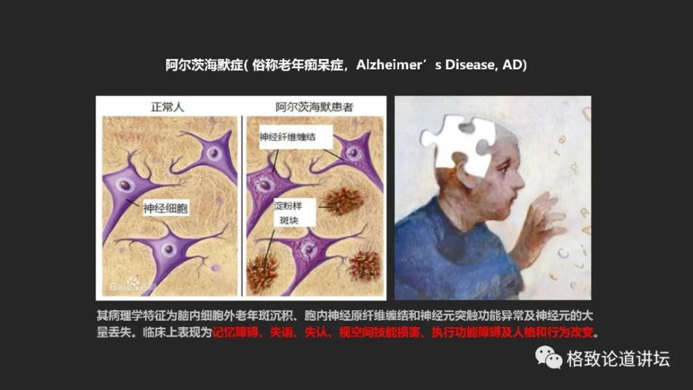 它的病理學特徵是腦內細胞外老年斑沉澱和神經細胞內原纖維纏結和神經