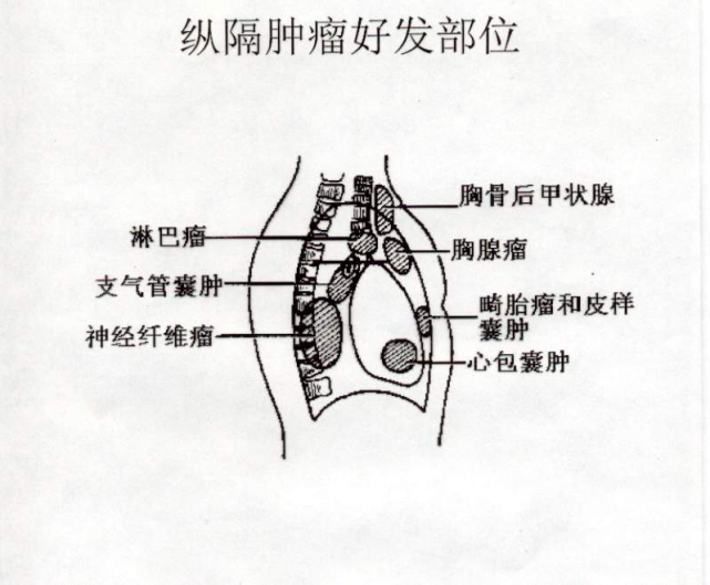 纵隔肿瘤的分类
