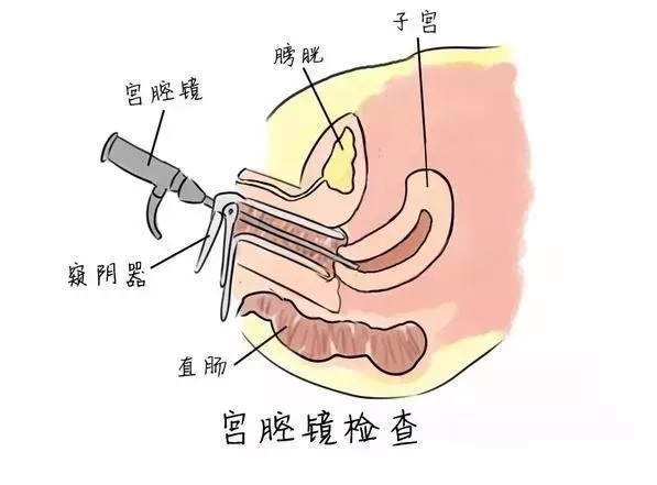 请你进"宫",跟着宫腔镜去探索宝宝的第一所房子