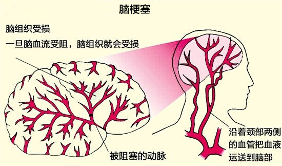 脑栓通的功效、脑栓通的作用。