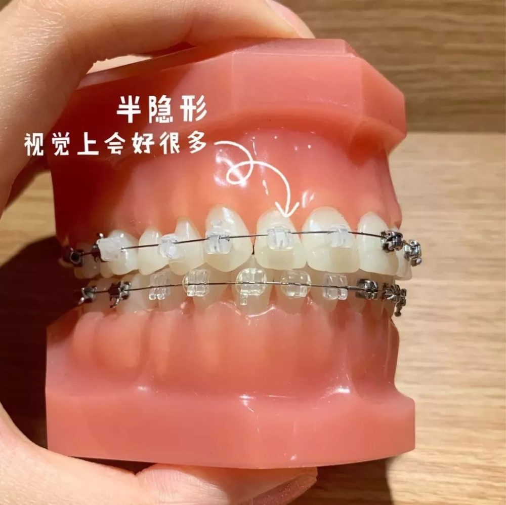 大连齿医生口腔科普想矫正又不知道怎么选牙套点这里