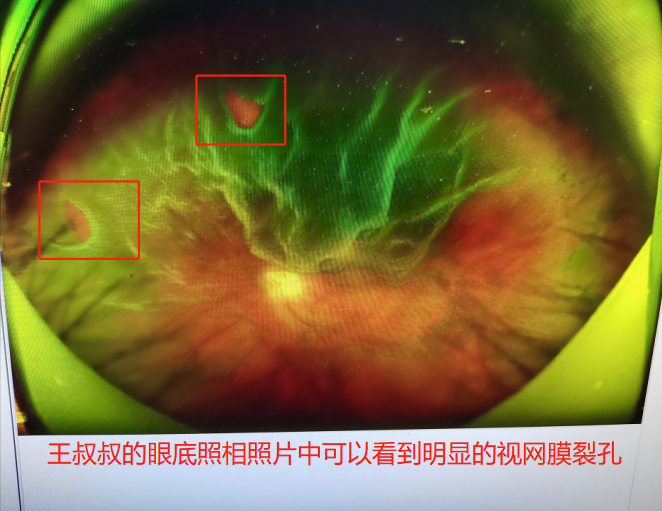 六旬老人眼睛出现闪光和飞蚊去医院一查竟是视网膜脱离