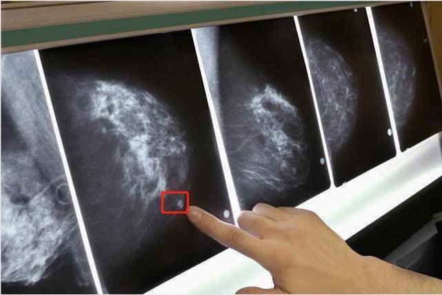 医生:男性也会得乳腺癌,注意3大症状
