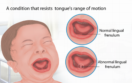 孩子说话晚、发音不清是因为舌系带过短？