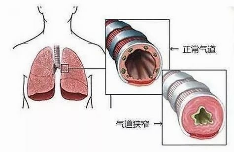 纵膈内淋巴结转移压迫支气管