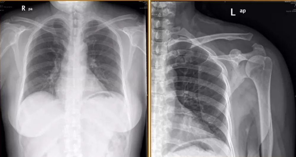 肩锁关节脱位的分型及治疗,值得收藏!