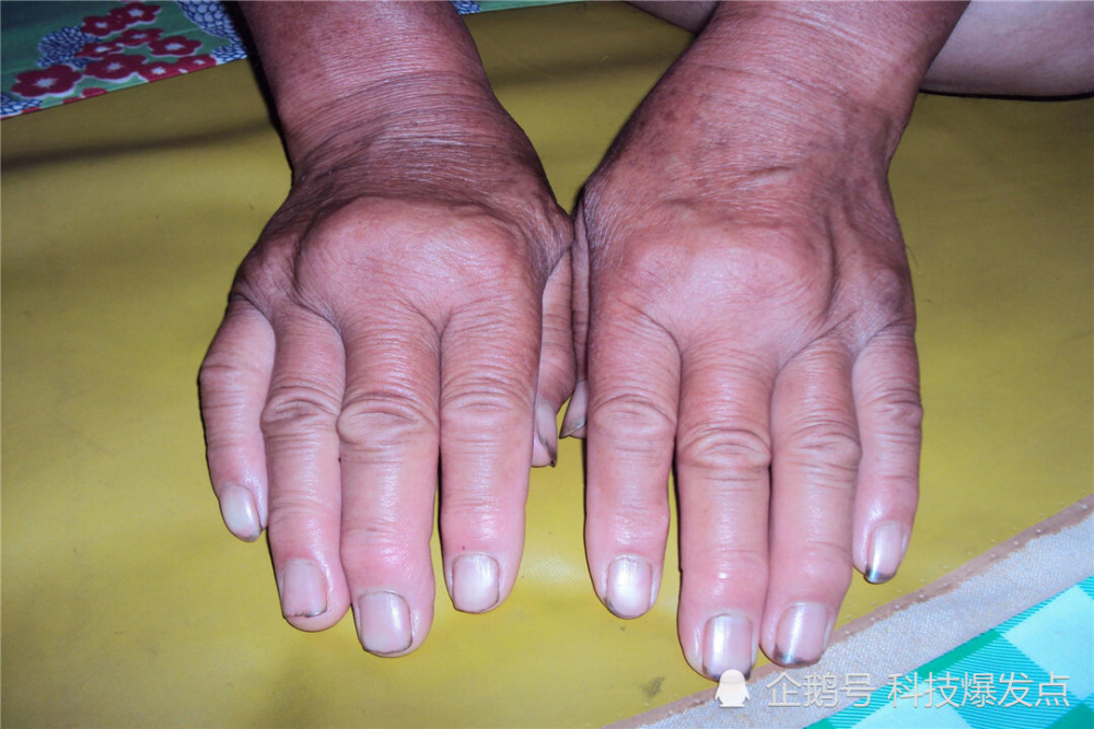 总有人把手指掰出声响,你觉得很酷吗?实则危害身体健康!