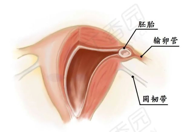 间质部妊娠&宫角妊娠如何鉴别?可不都是异位妊娠这么简单