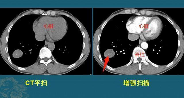 早期肺癌ct图片图解图片