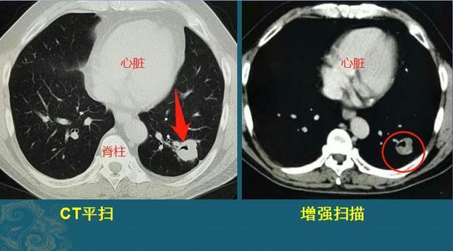 早期肺癌ct图图解影像图片