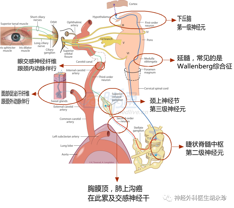 无汗|眼裂减小，颜面无汗，瞳孔缩小，要注意这类疾病