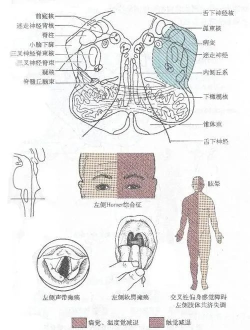 无汗|眼裂减小，颜面无汗，瞳孔缩小，要注意这类疾病