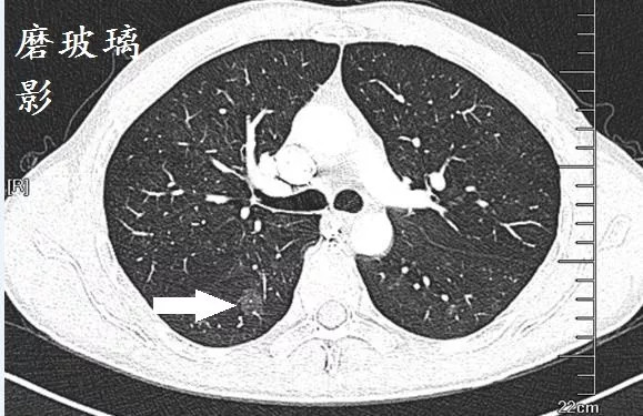 假如出現阻塞性肺炎,更支持鱗癌.