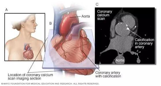冠状动脉钙化|突发心脏病后，他开始高脂饮食，冠状动脉钙化竟然下降40％