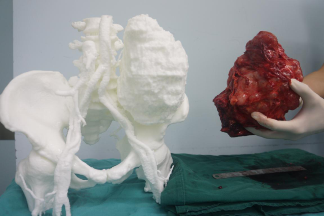 疯长三年的巨大髂骨肉瘤被切除!