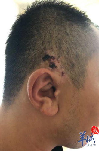 耳朵被树枝刮断一半广州医生成功帮其修复