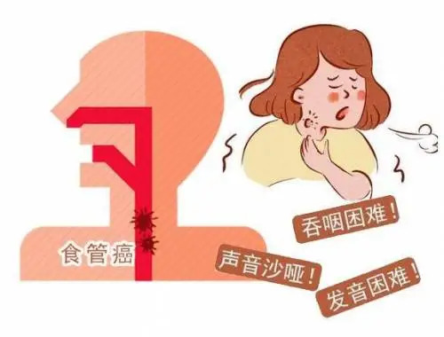 进行性吞咽困难图片