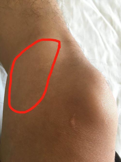 膝盖滑膜炎的治疗