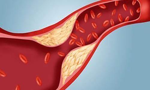 黄色瘤|脸上出现这4个变化，可能是体内血脂水平超标了，别不当回事！