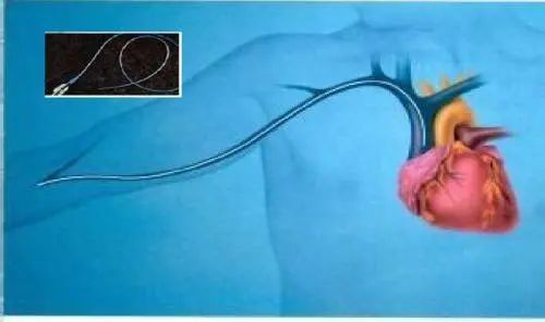 picc置管,你需要知道的几件事