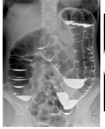 但是,钡剂要是渗漏到腹部及盆腔,可能引起严重并发症,如腹膜炎.