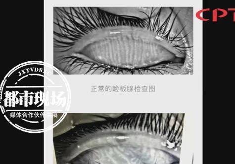 这名艺人左眼的睑板腺完全萎缩,形态如同五十岁老人眼睛,右眼也有部分