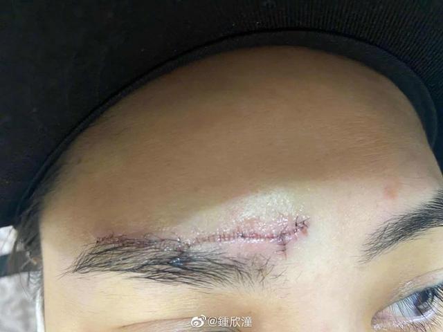 钟欣潼|阿娇受伤后首晒自拍照，伤口触目惊心，坦言留疤感叹遮瑕膏的发明