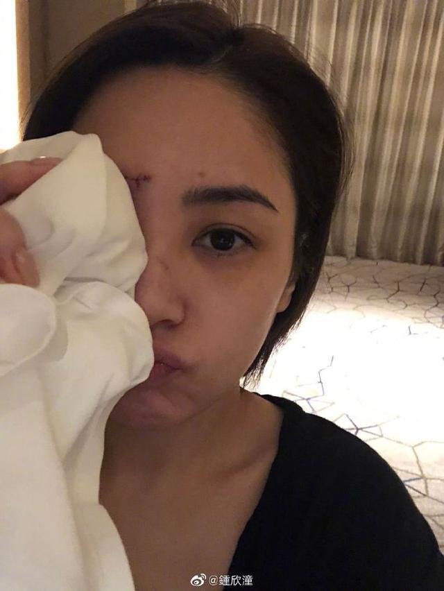 钟欣潼|阿娇受伤后首晒自拍照，伤口触目惊心，坦言留疤感叹遮瑕膏的发明