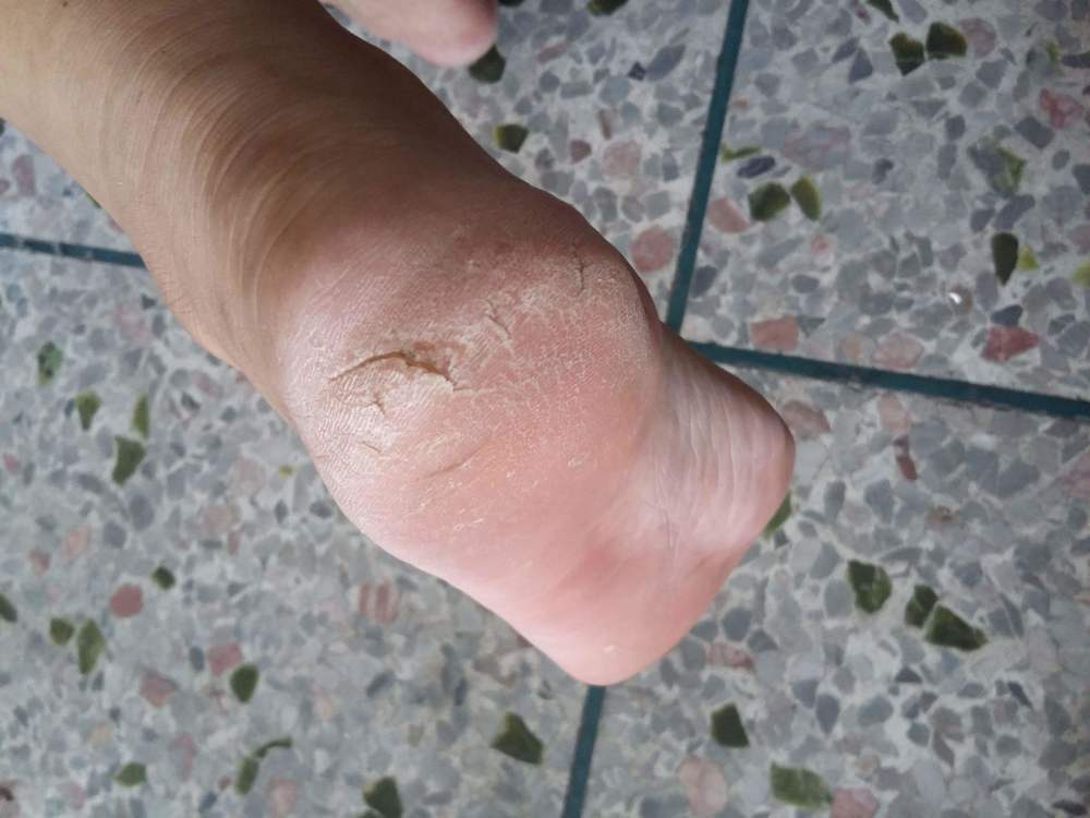 脚后跟经常干裂起皮,是什么原因导致的呢?3个原因了解一下
