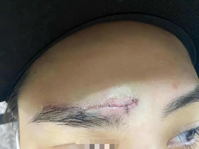 钟欣潼|阿娇额头伤口曝光！看完后头皮发麻，疤痕明显还未恢复