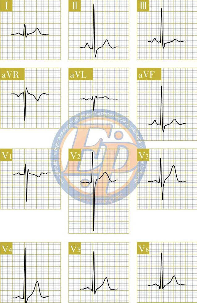 完全性右束支阻滞及其合并心肌梗死的心电图特点
